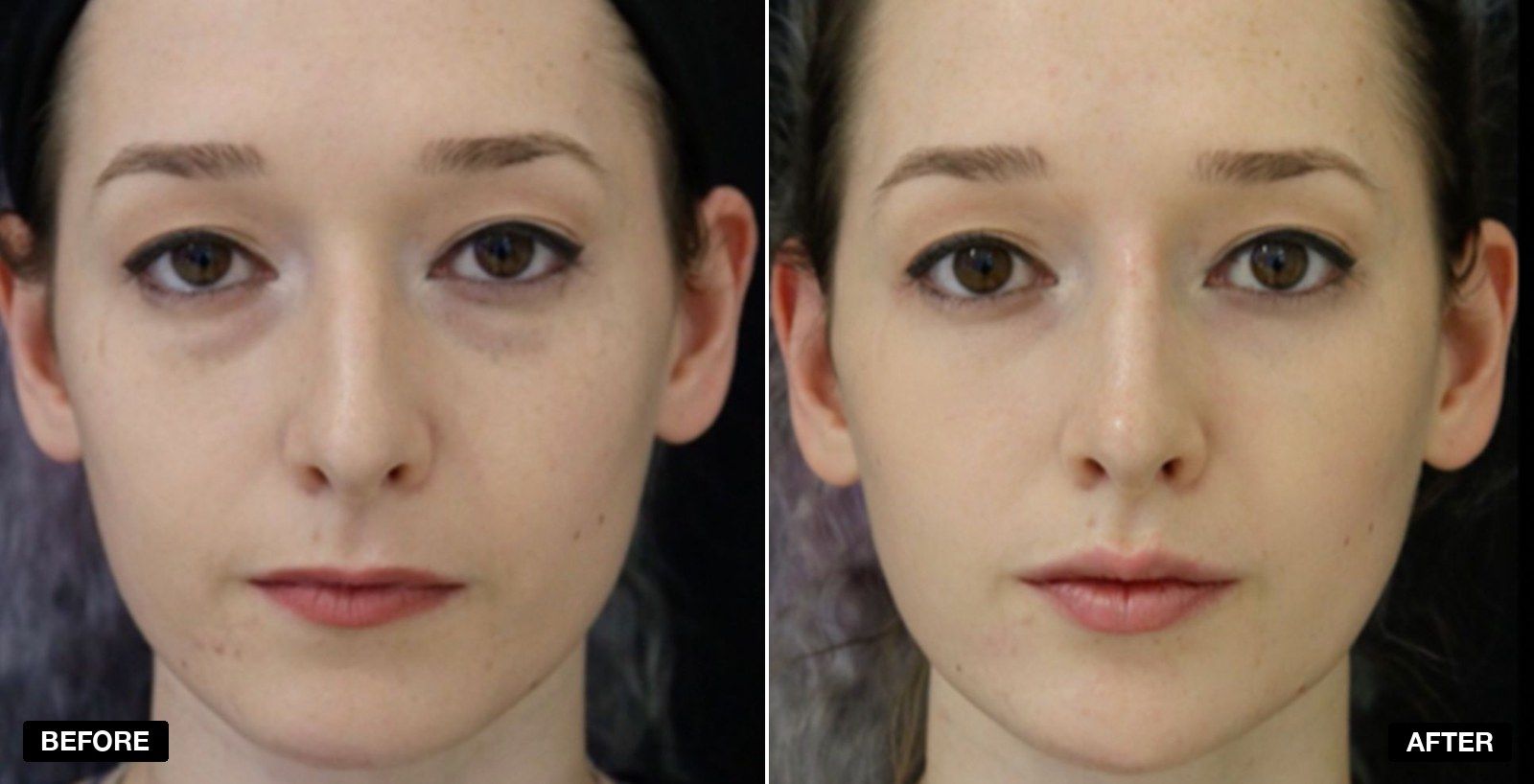 Non surgical facelift before and after images - patient case 5 of 8 at PHI Clinic London