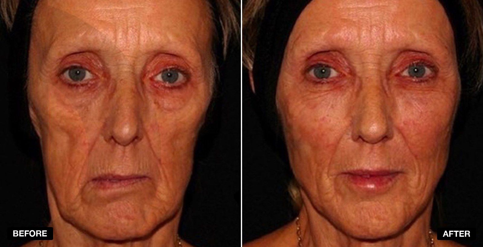 Non surgical facelift before and after images - patient case 6 of 8 at PHI Clinic London