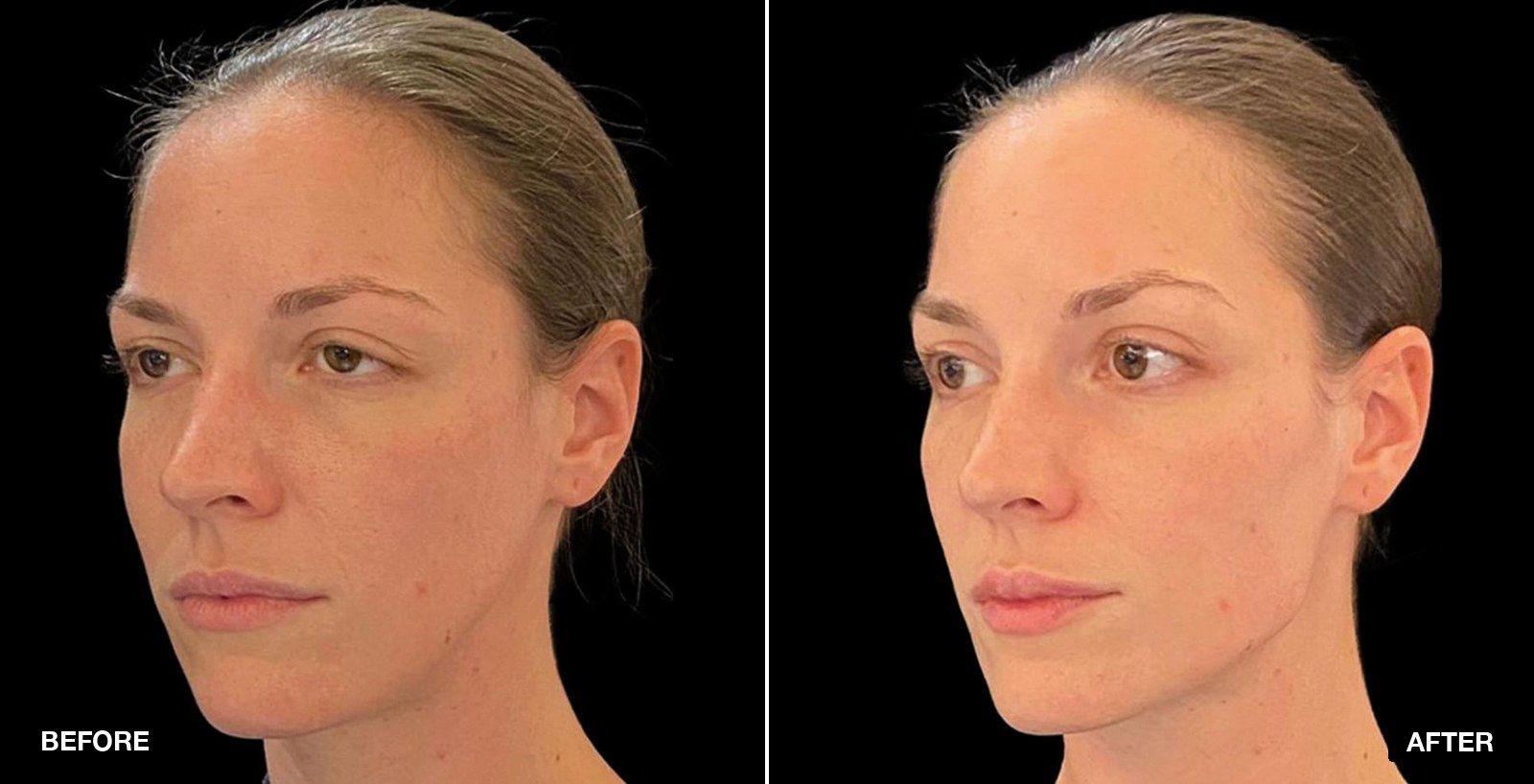 Non surgical facelift before and after images - patient case 7 of 8 at PHI Clinic London