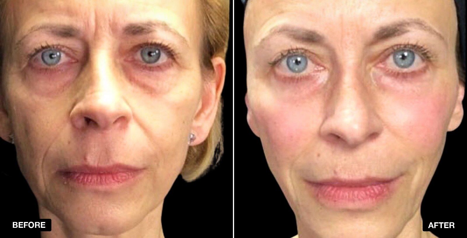 Non surgical facelift before and after images - patient case 8 of 8 at PHI Clinic London