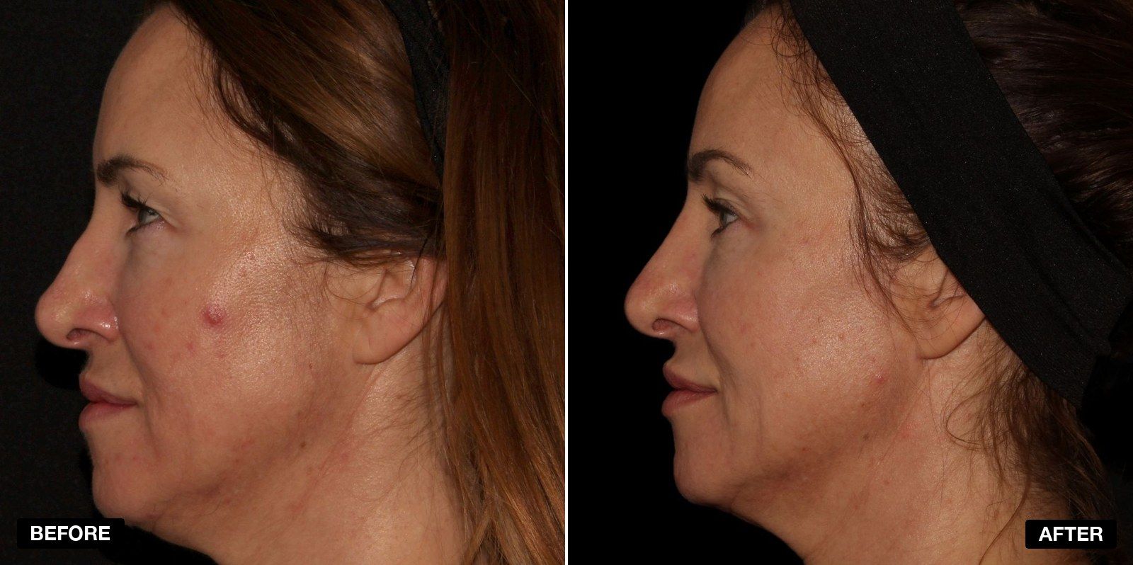 Nose filler before and after - patient case 3 of 8 at PHI Clinic London