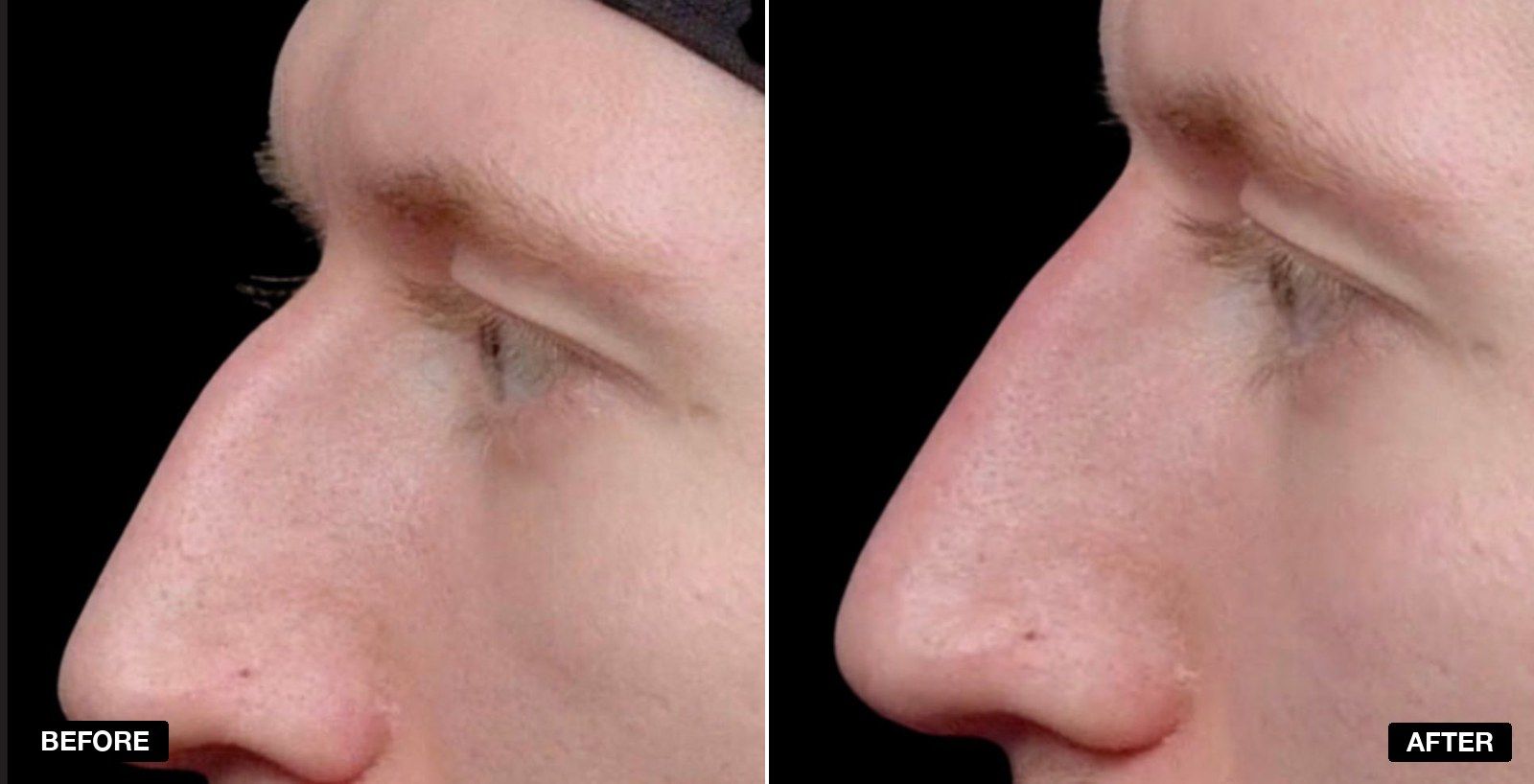 Nose filler before and after - patient case 5 of 8 at PHI Clinic London