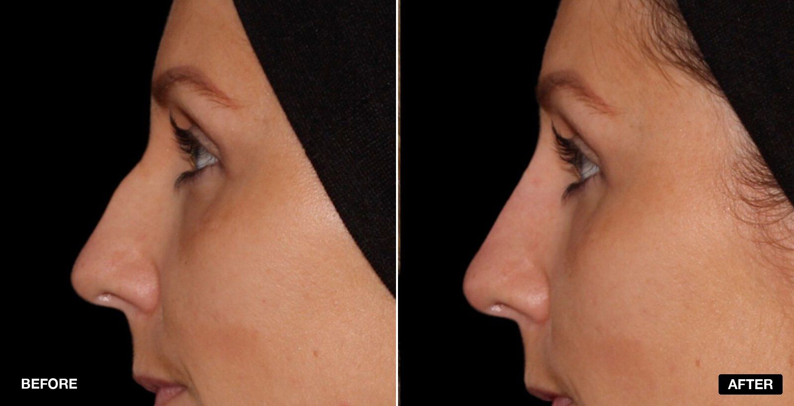 Nose filler before and after - patient case 7 of 8 at PHI Clinic London