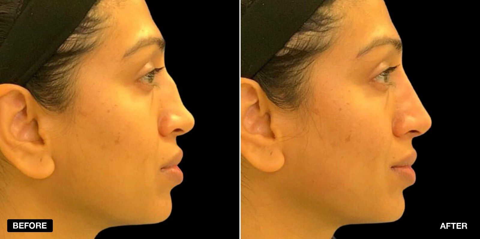 Nose fillers before and after - patient case 2 of 3 at PHI Clinic London