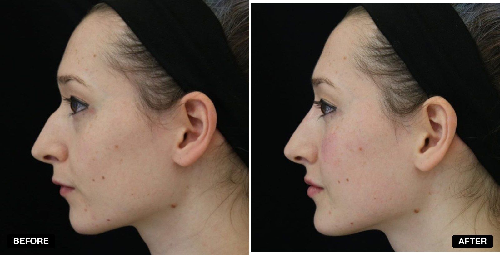 Nose fillers before and after - patient case 3 of 3 at PHI Clinic London