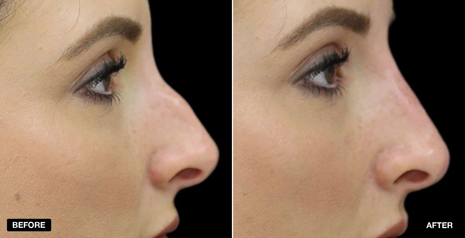 Nose reshaping before and after - patient case 1 of 3 at PHI Clinic London