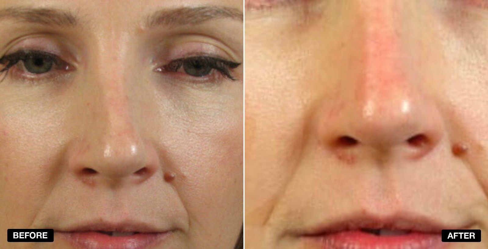Nose reshaping before and after - patient case 2 of 3 at PHI Clinic London