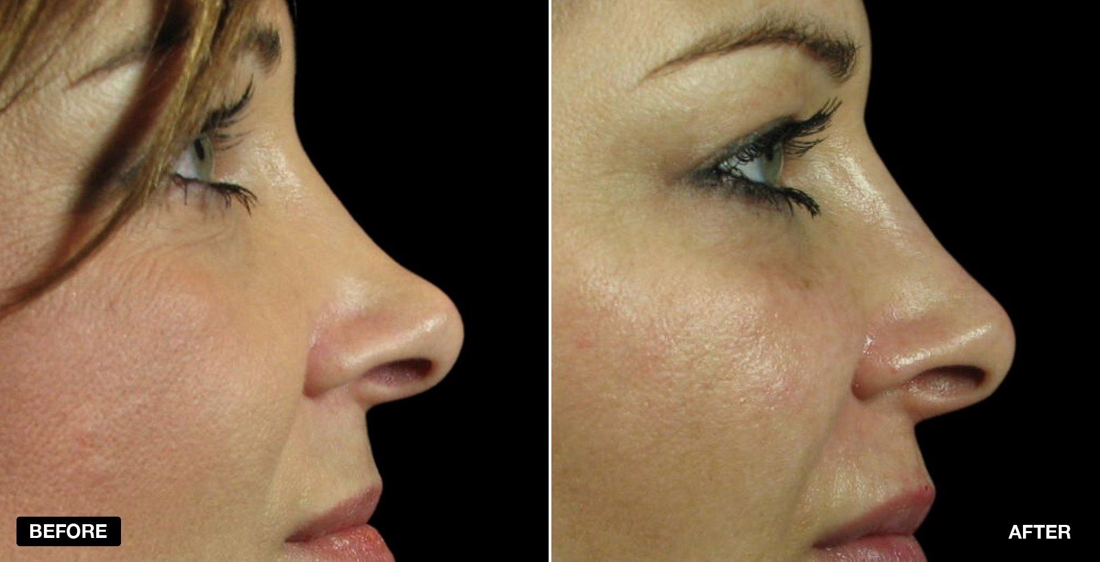 Nose reshaping before and after - patient case 3 of 3 at PHI Clinic London