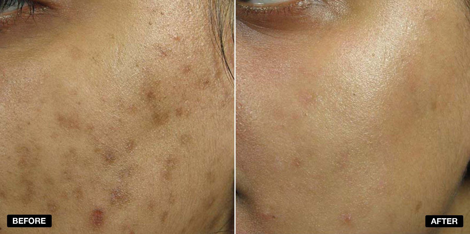 Obagi skincare transformations - patient case 1 of 5 at PHI Clinic London