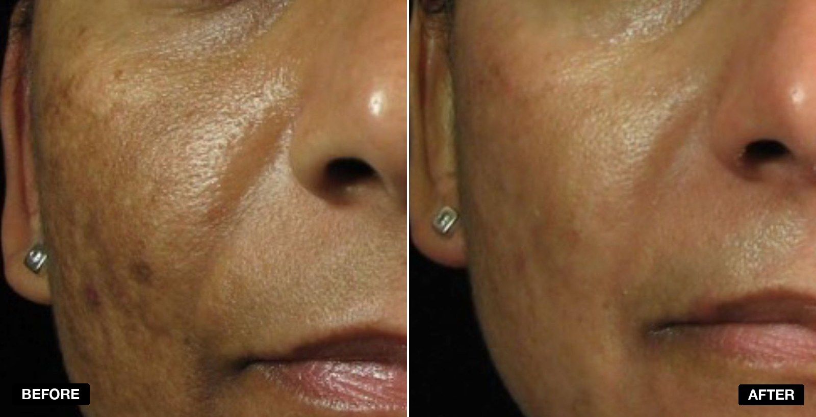 Obagi skincare transformations - patient case 5 of 5 at PHI Clinic London
