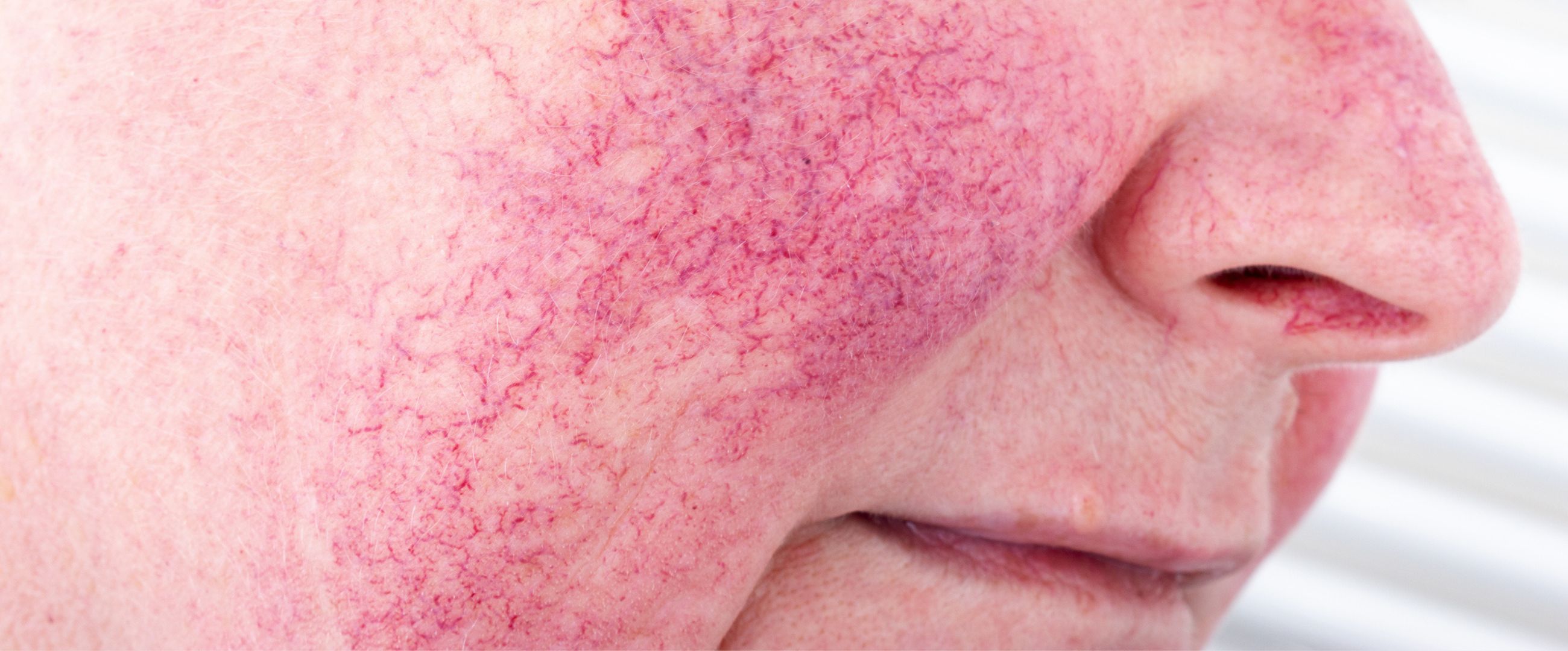 older woman with redness on face