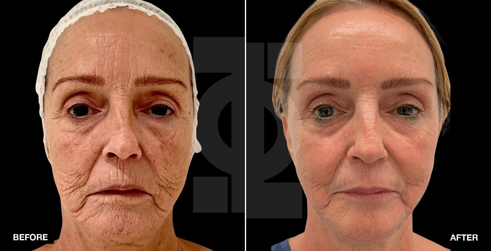 Our Transformations - patient case 2 of 3 at PHI Clinic London