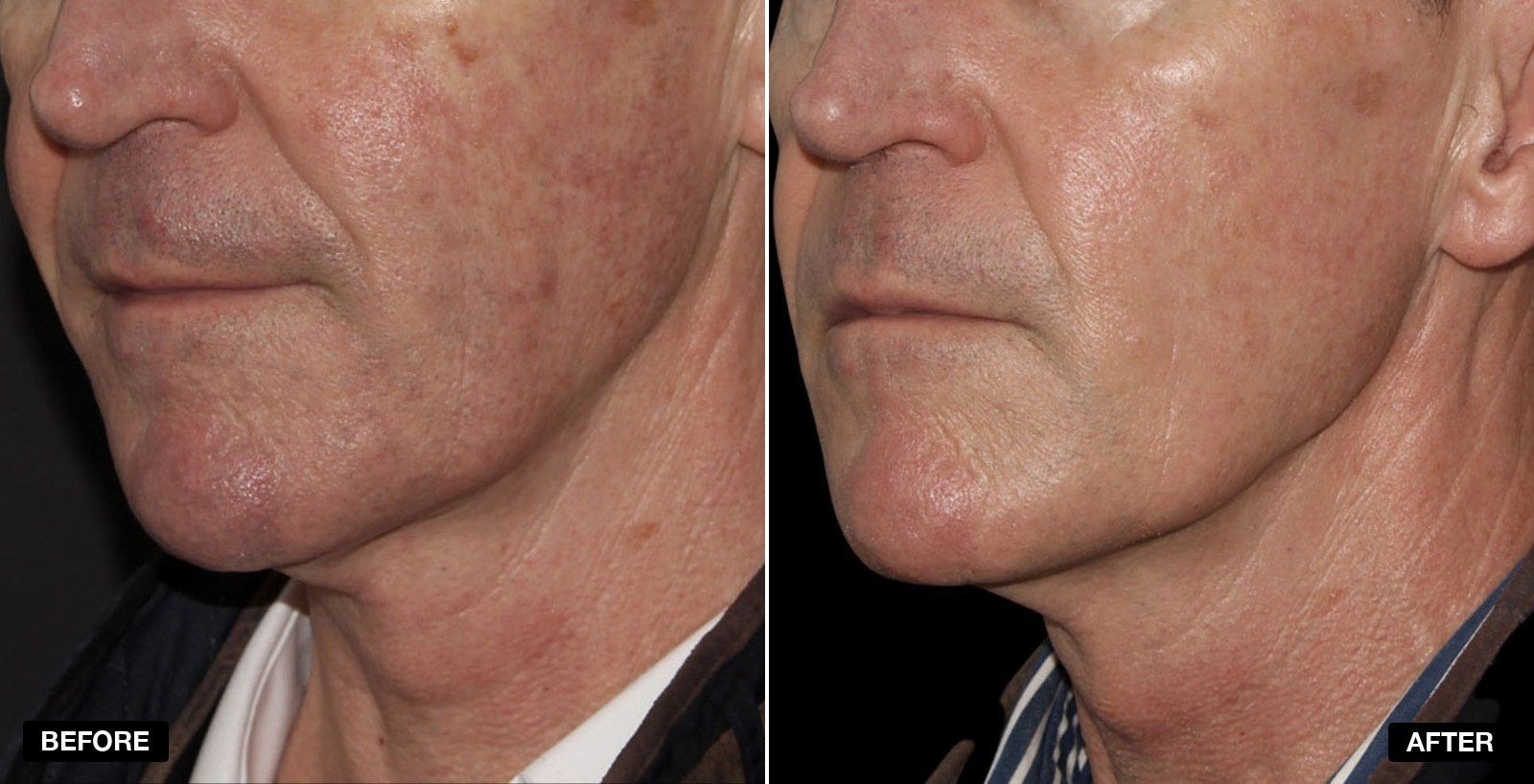 PHI Triple Repair transformations - patient case 1 of 1 at PHI Clinic London
