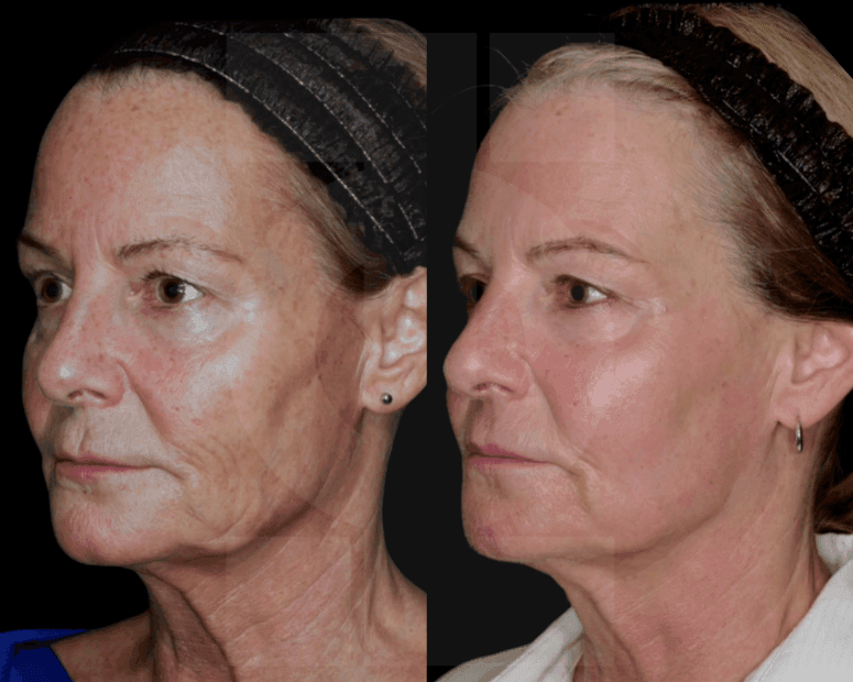 Endolift, Polynucleotides and JetPeel Before and After Result