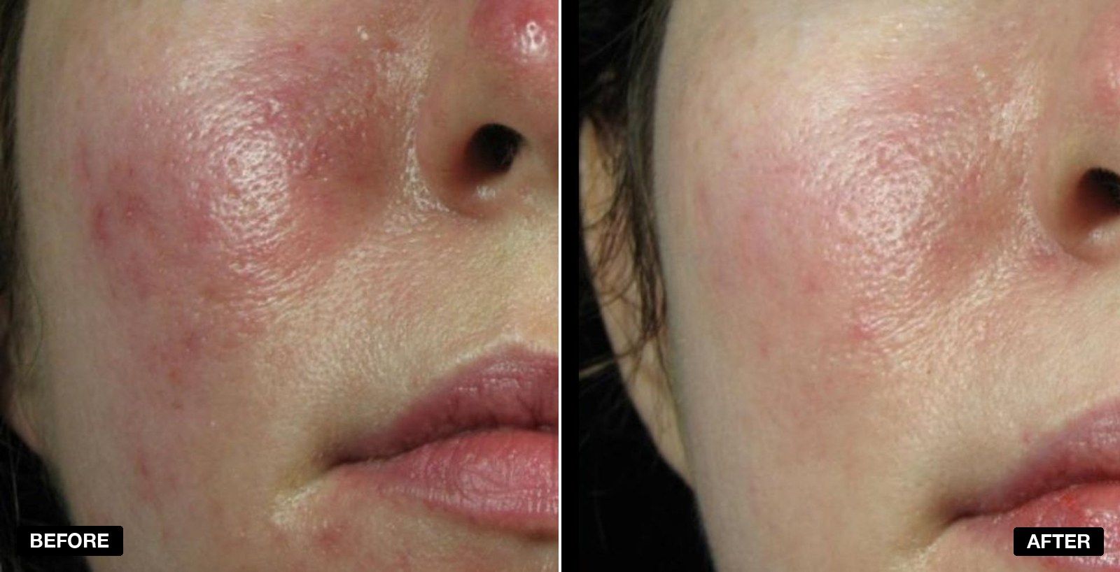 Pulsed Dye Laser transformations - patient case 1 of 1 at PHI Clinic London
