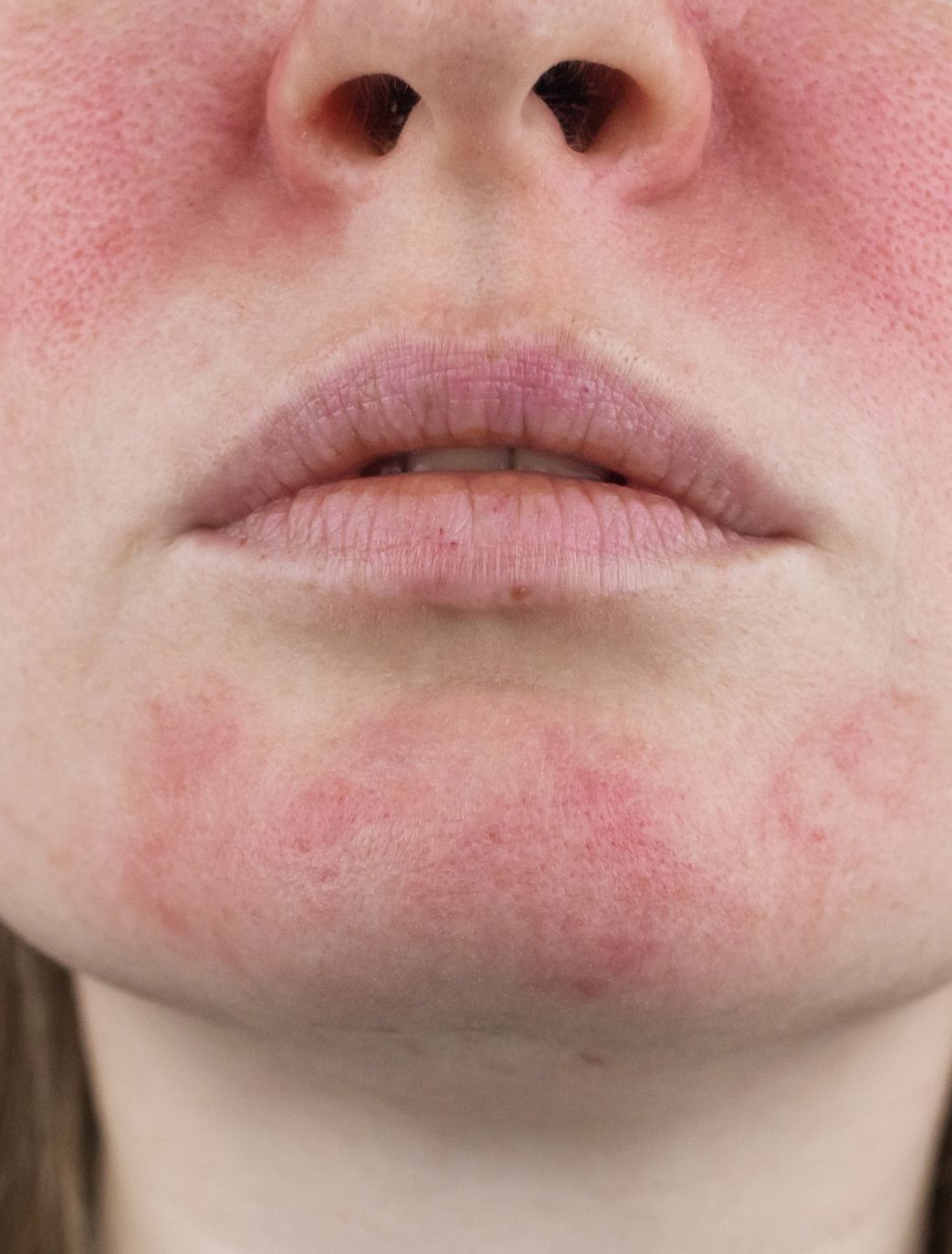 https://production-phi-static.ams3.cdn.digitaloceanspaces.com/rosacea_treatment_in_london_c168895510.jpg