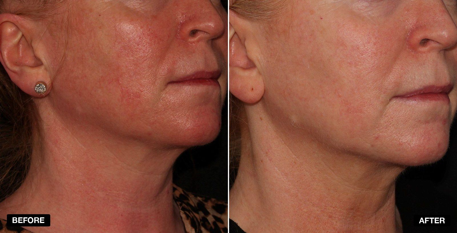 Rosacea Treatment London - PHI Clinic - patient case 1 of 1 at PHI Clinic London