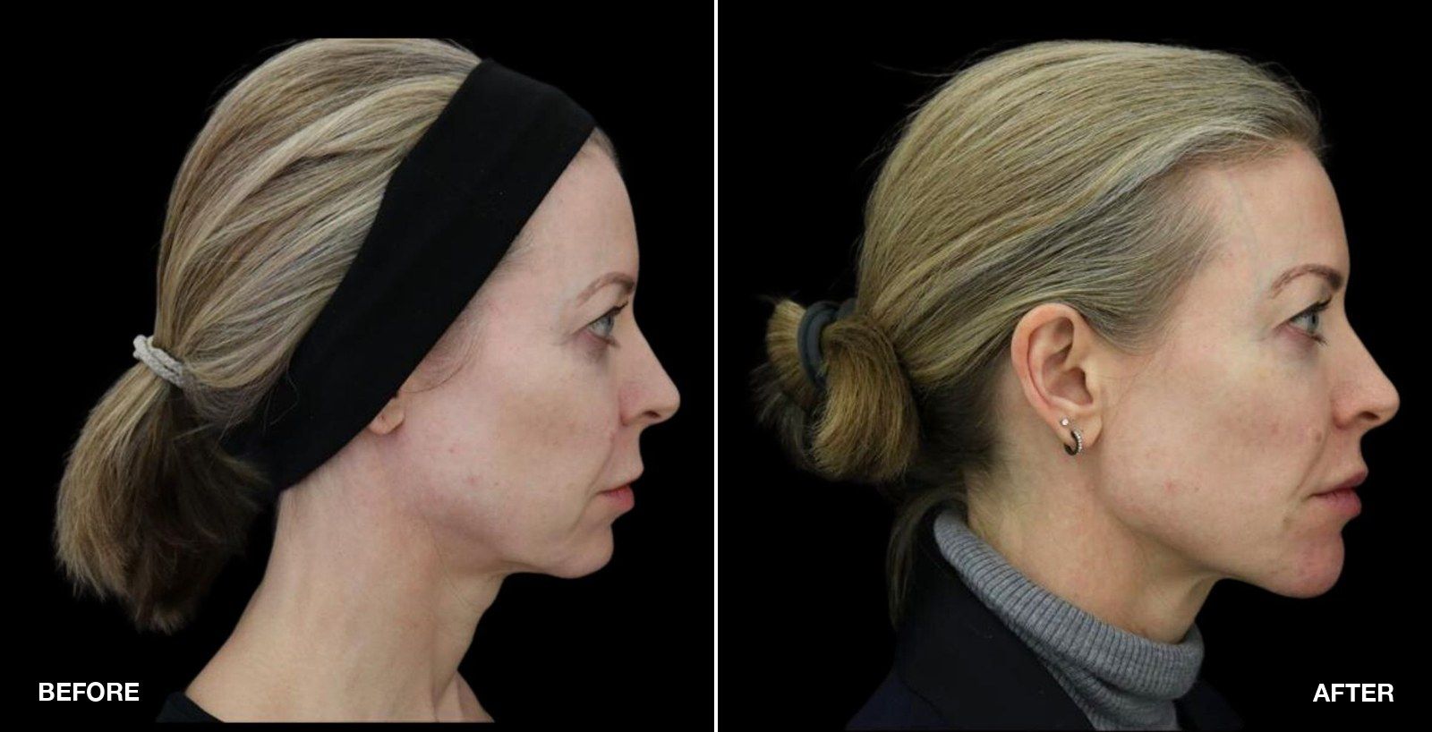 Sagging jowls before and after - patient case 1 of 2 at PHI Clinic London