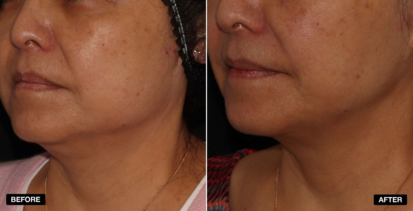 Sagging Neck transformations - patient case 2 of 2 at PHI Clinic London