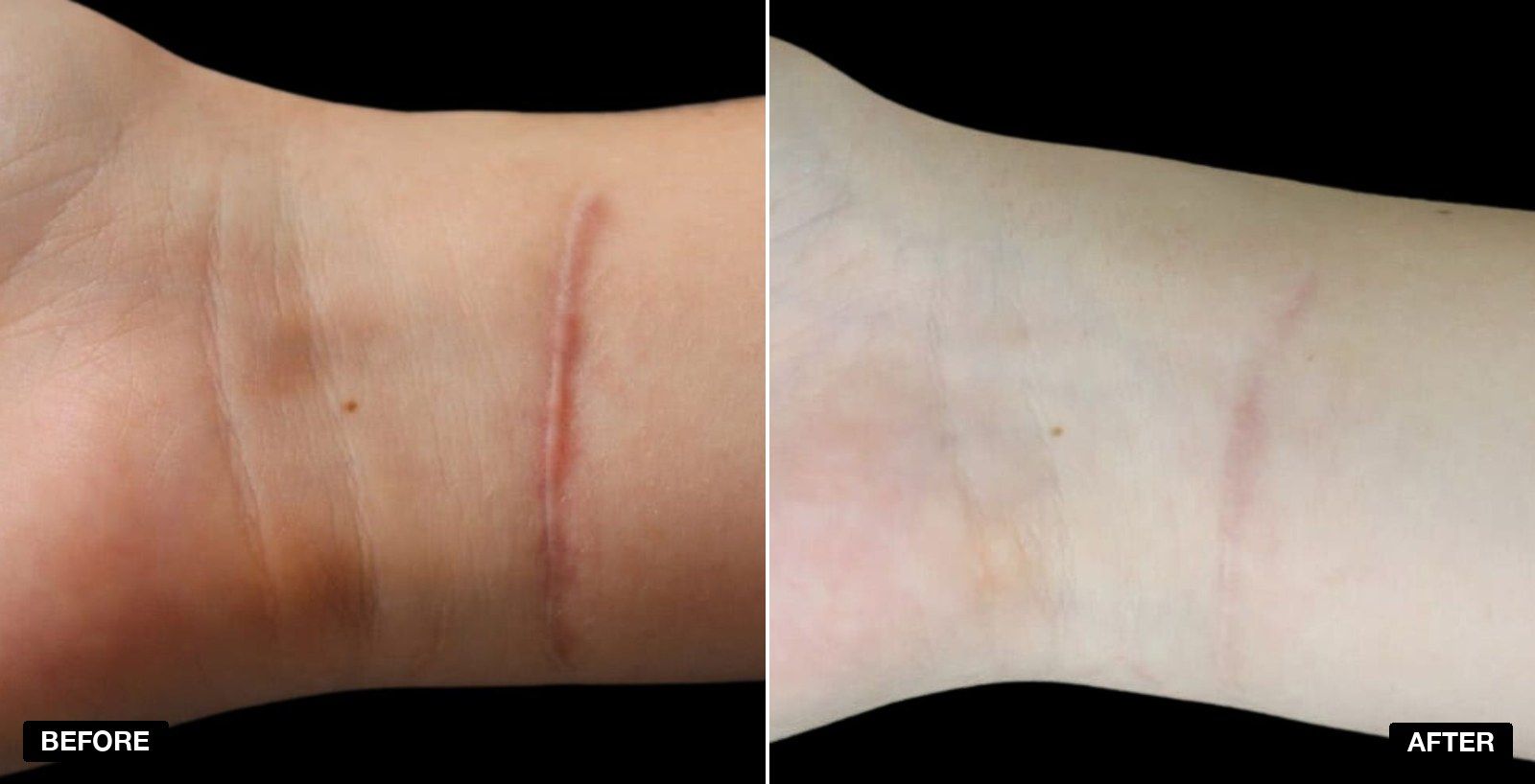 Scarring transformations - patient case 1 of 3 at PHI Clinic London