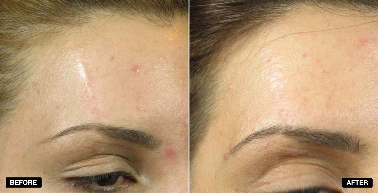 Scarring transformations - patient case 2 of 3 at PHI Clinic London