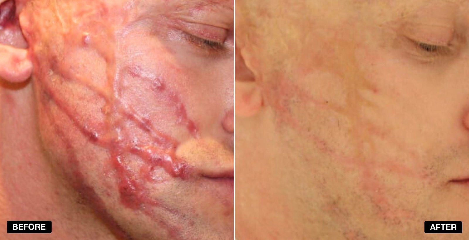 Scarring transformations - patient case 3 of 3 at PHI Clinic London