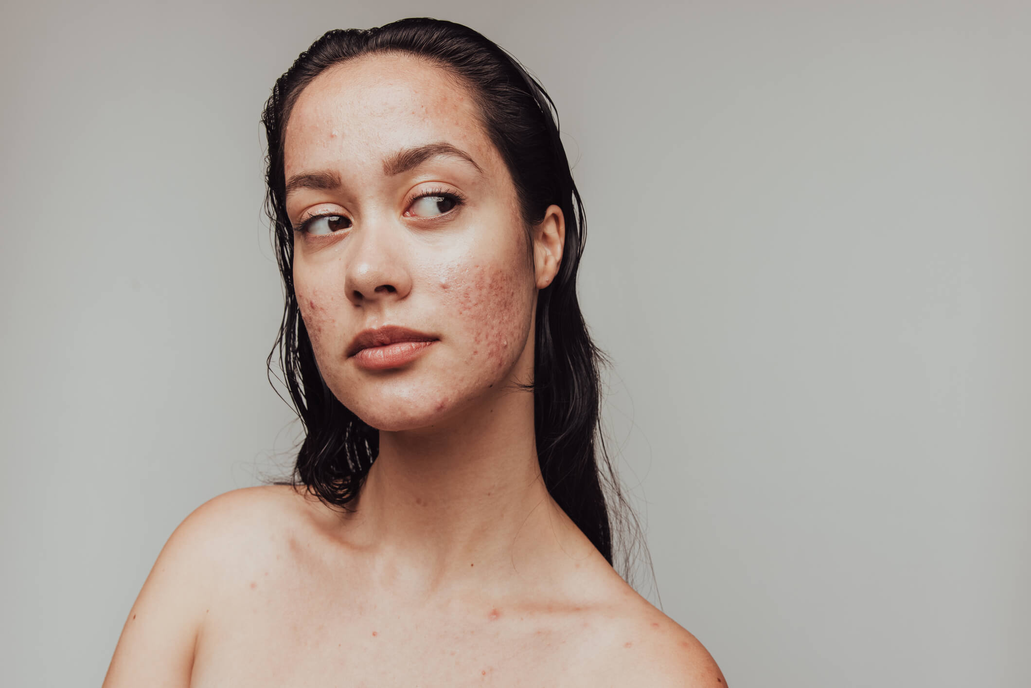 seasonal acne image