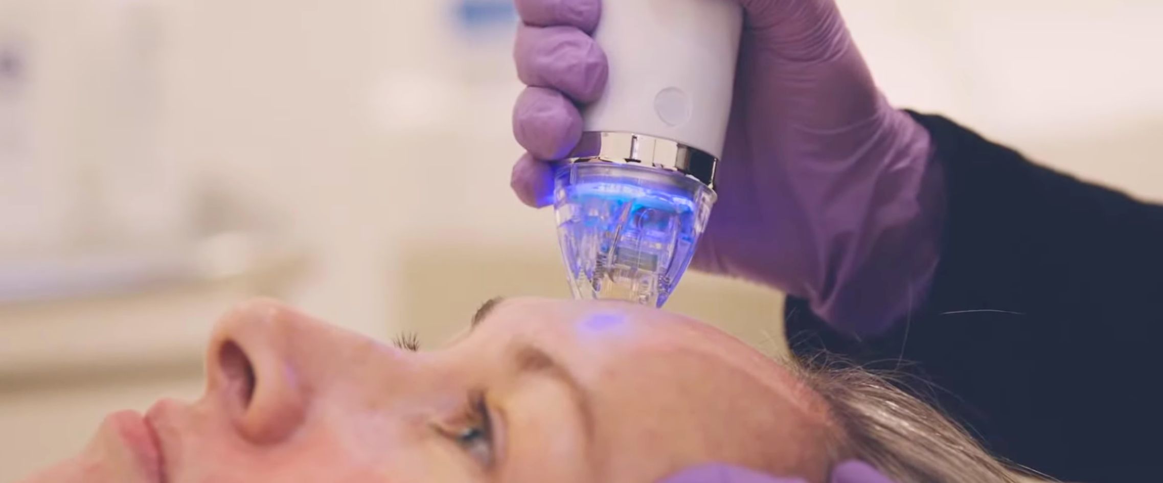 secret rf treatment upclose