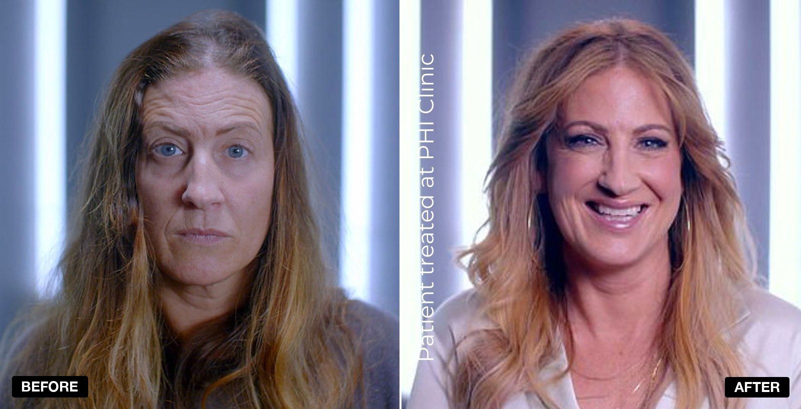 Skin tightening before and after - patient case 1 of 4 at PHI Clinic London