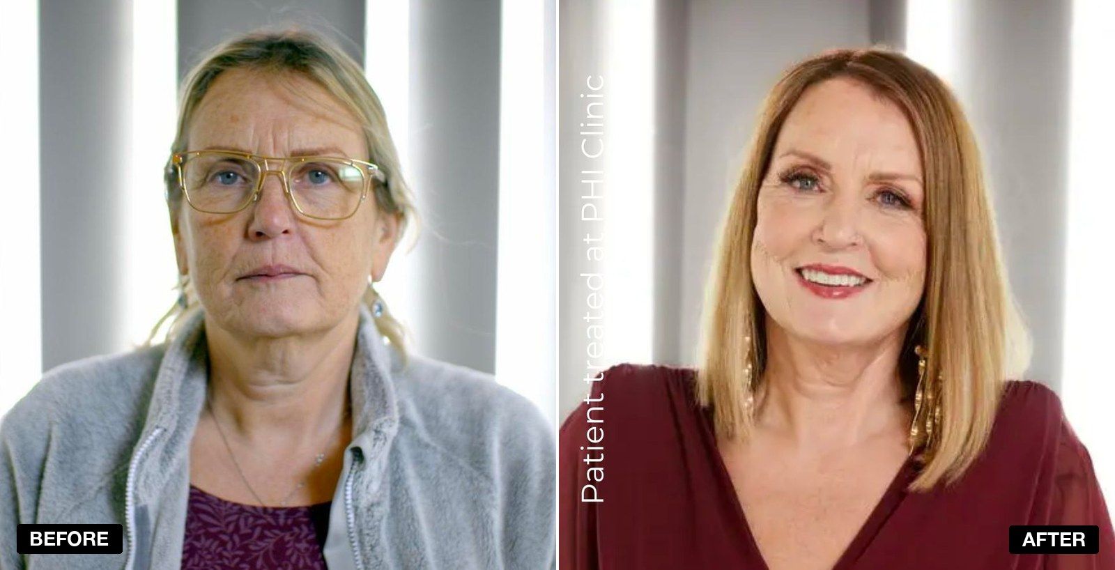 Skin tightening before and after - patient case 2 of 4 at PHI Clinic London