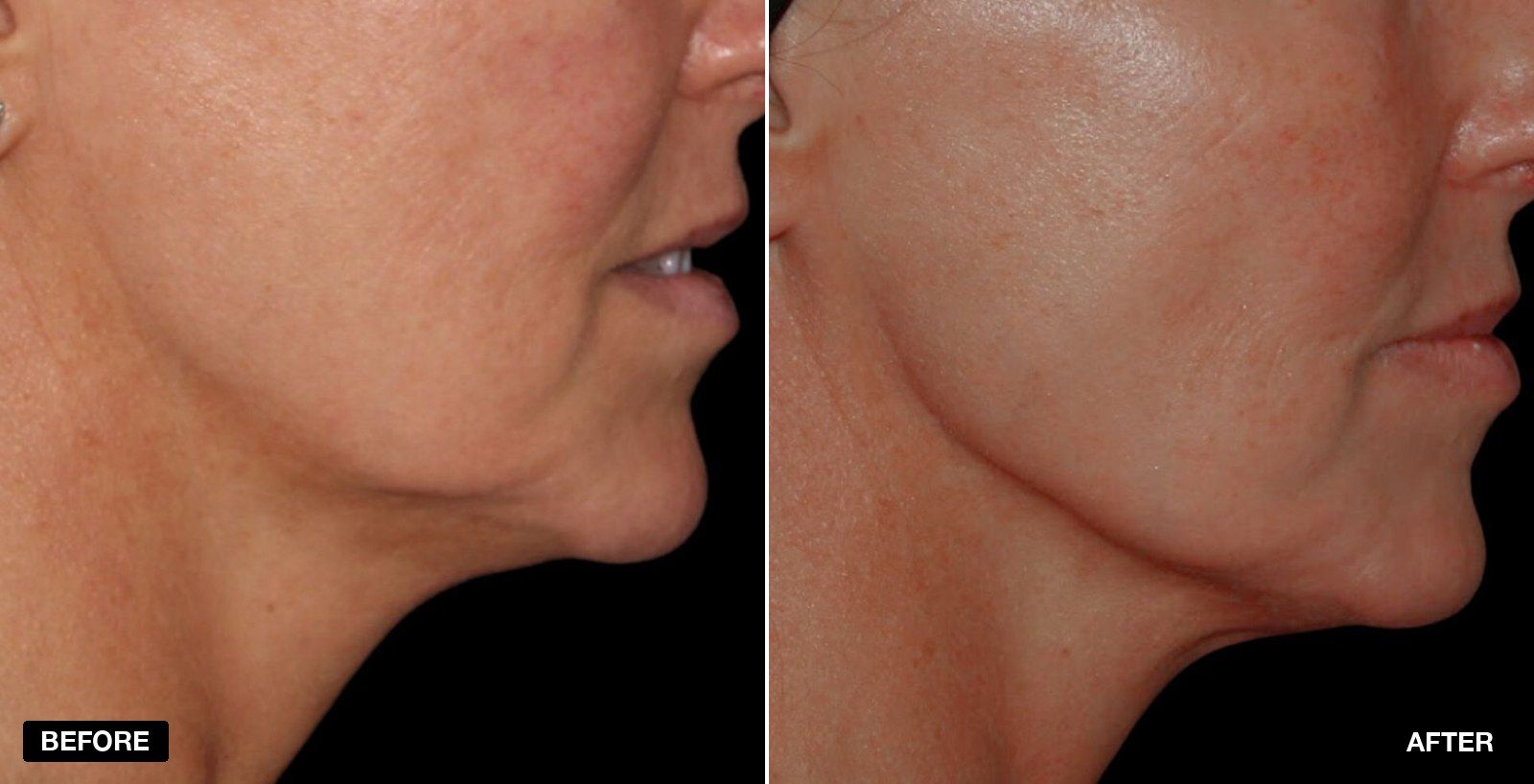Skin tightening before and after - patient case 4 of 4 at PHI Clinic London