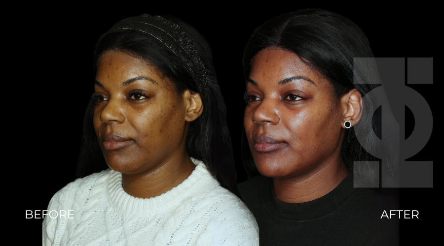 skin tightening endolift before and after