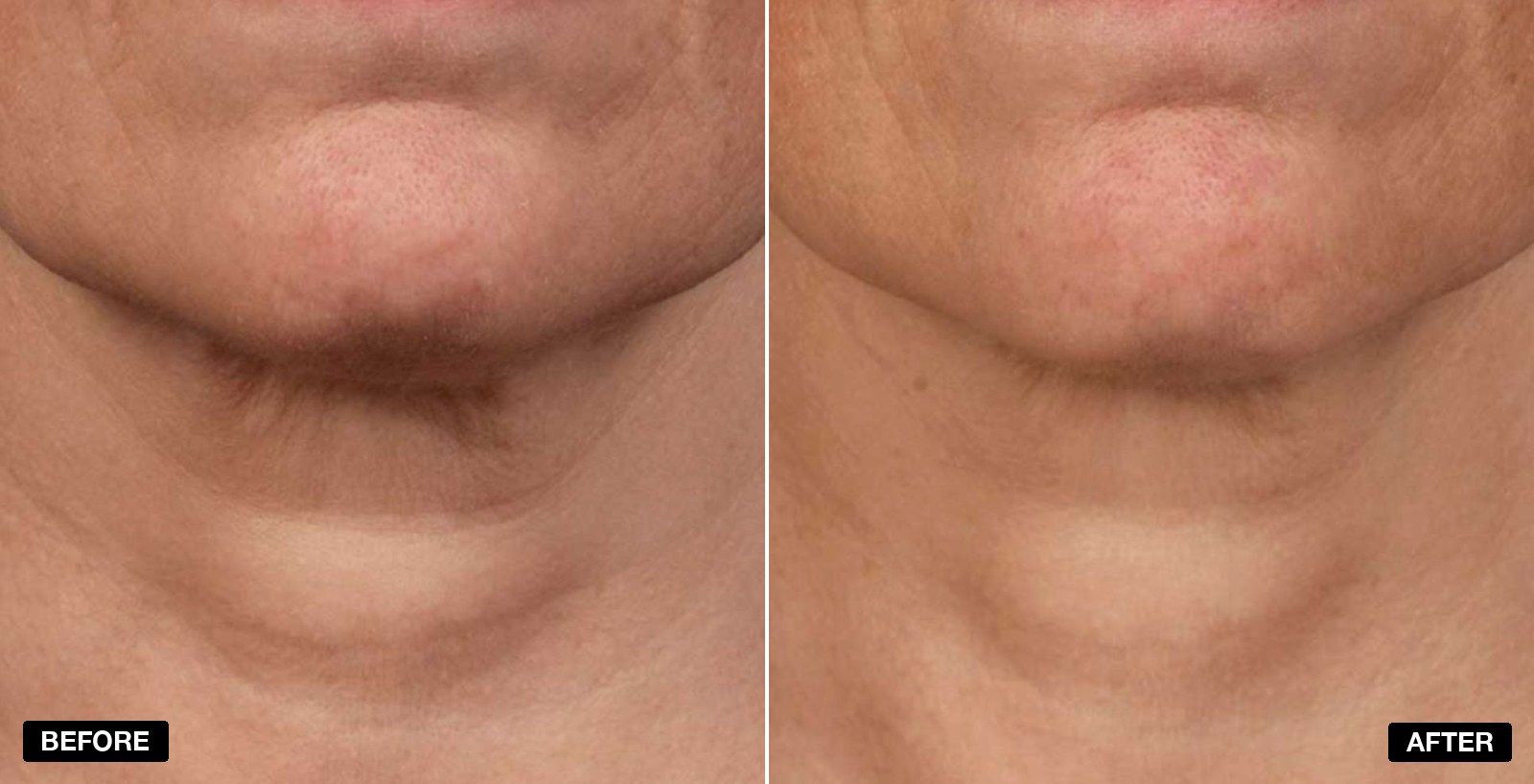 SkinPen transformations - patient case 1 of 1 at PHI Clinic London