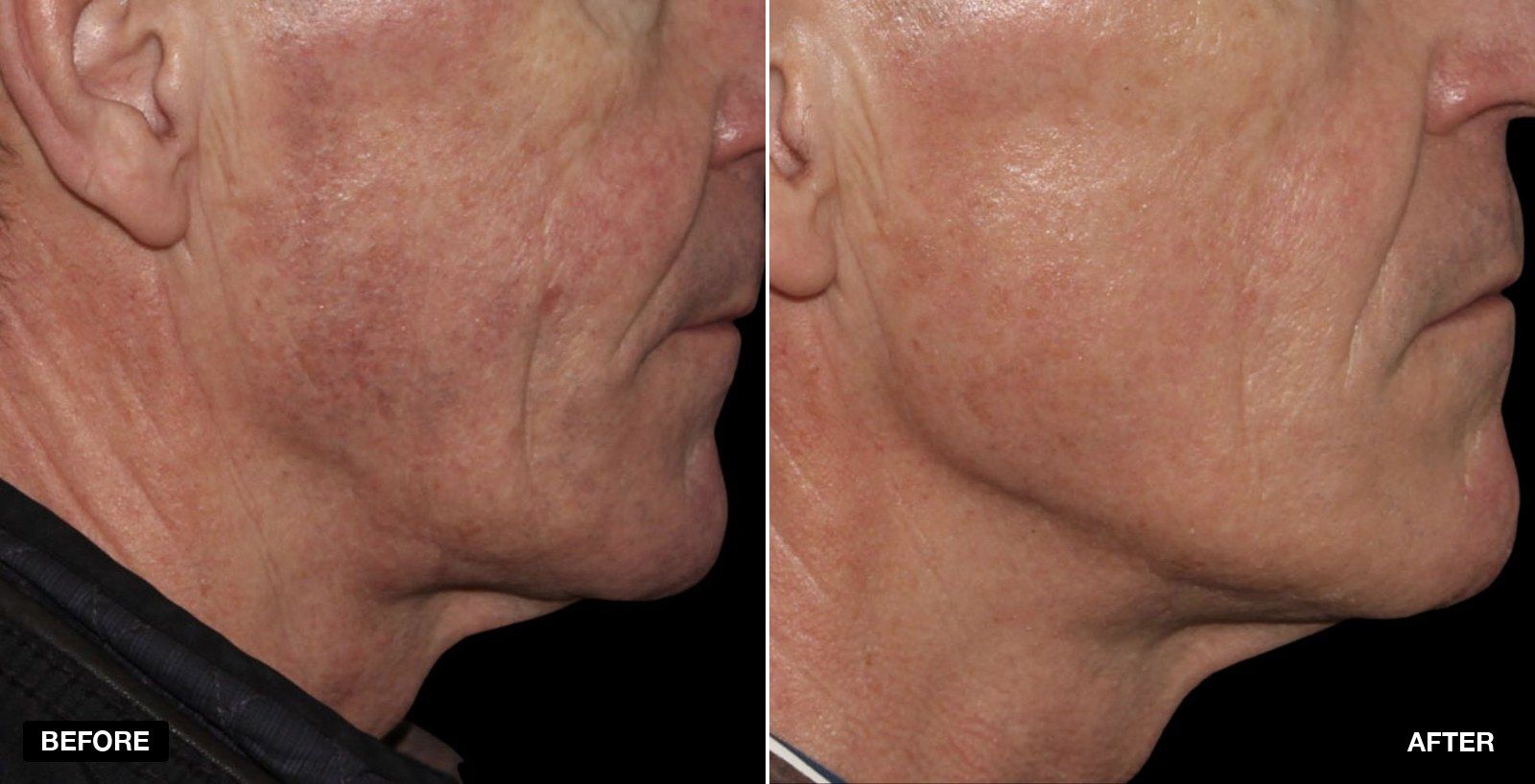 Stellar M22 transformations - patient case 1 of 4 at PHI Clinic London