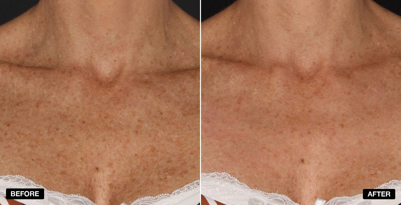 Stellar M22 transformations - patient case 3 of 4 at PHI Clinic London