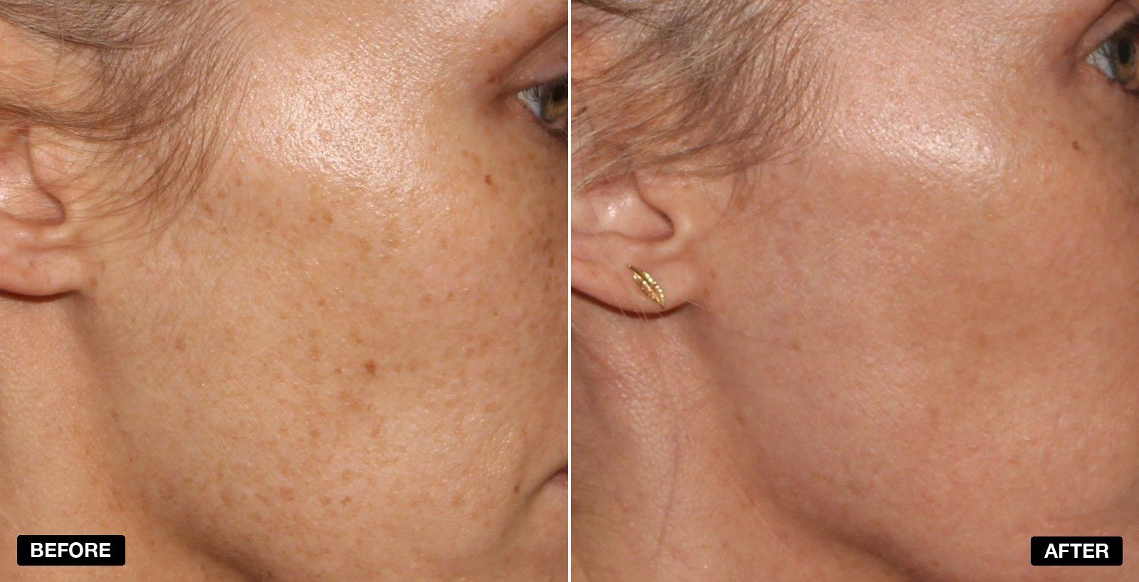 Stellar M22 transformations - patient case 4 of 4 at PHI Clinic London