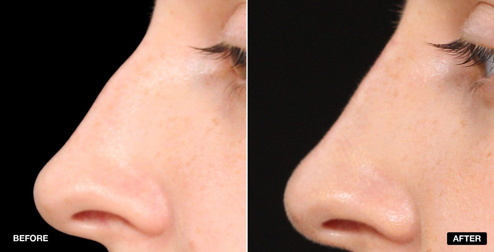 Straight nose before & after Images - patient case 2 of 4 at PHI Clinic London