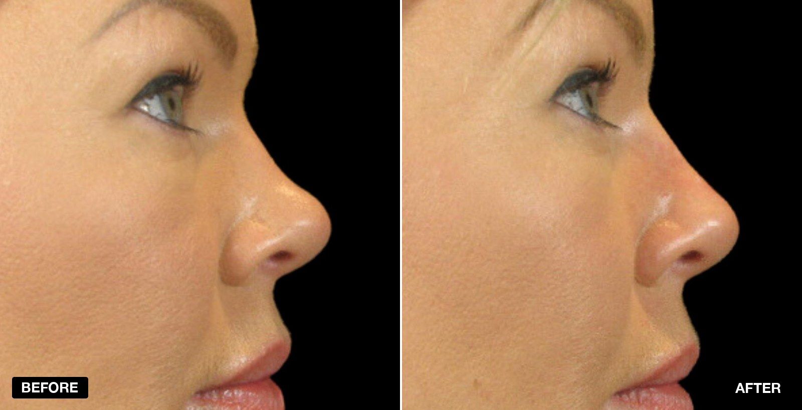 Straight nose before & after Images - patient case 3 of 4 at PHI Clinic London