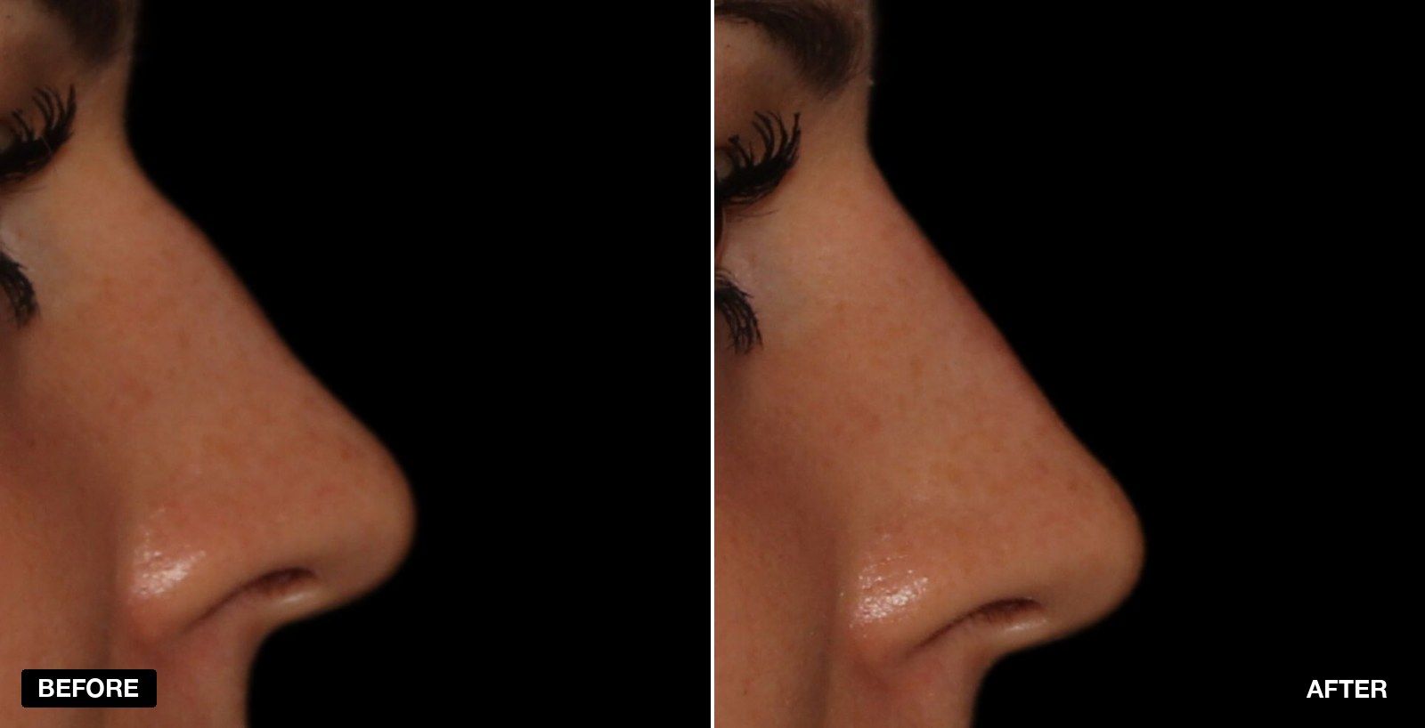 Straight nose before & after Images - patient case 4 of 4 at PHI Clinic London