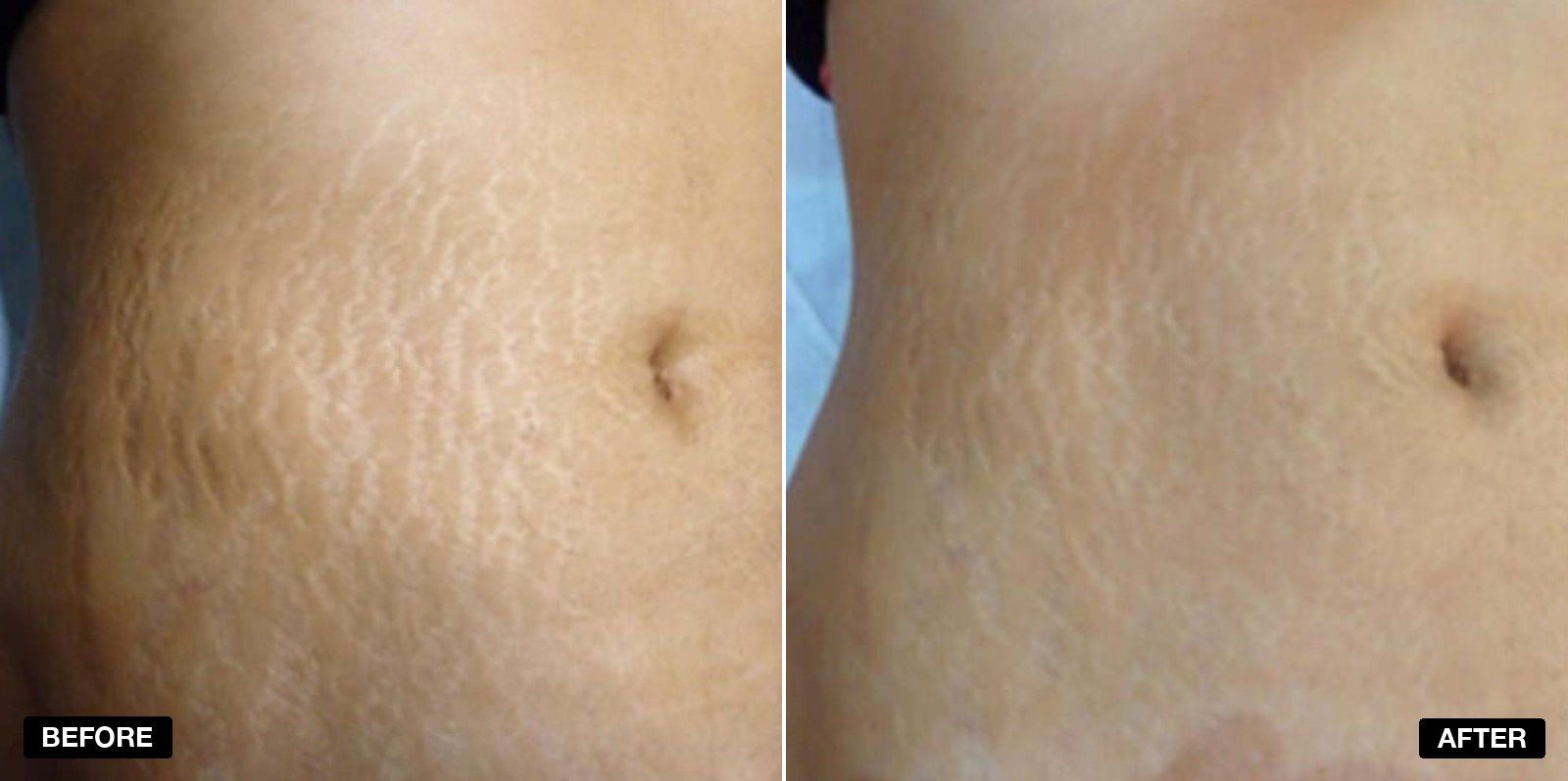 Stretch marks before and after treatment - patient case 1 of 1 at PHI Clinic London