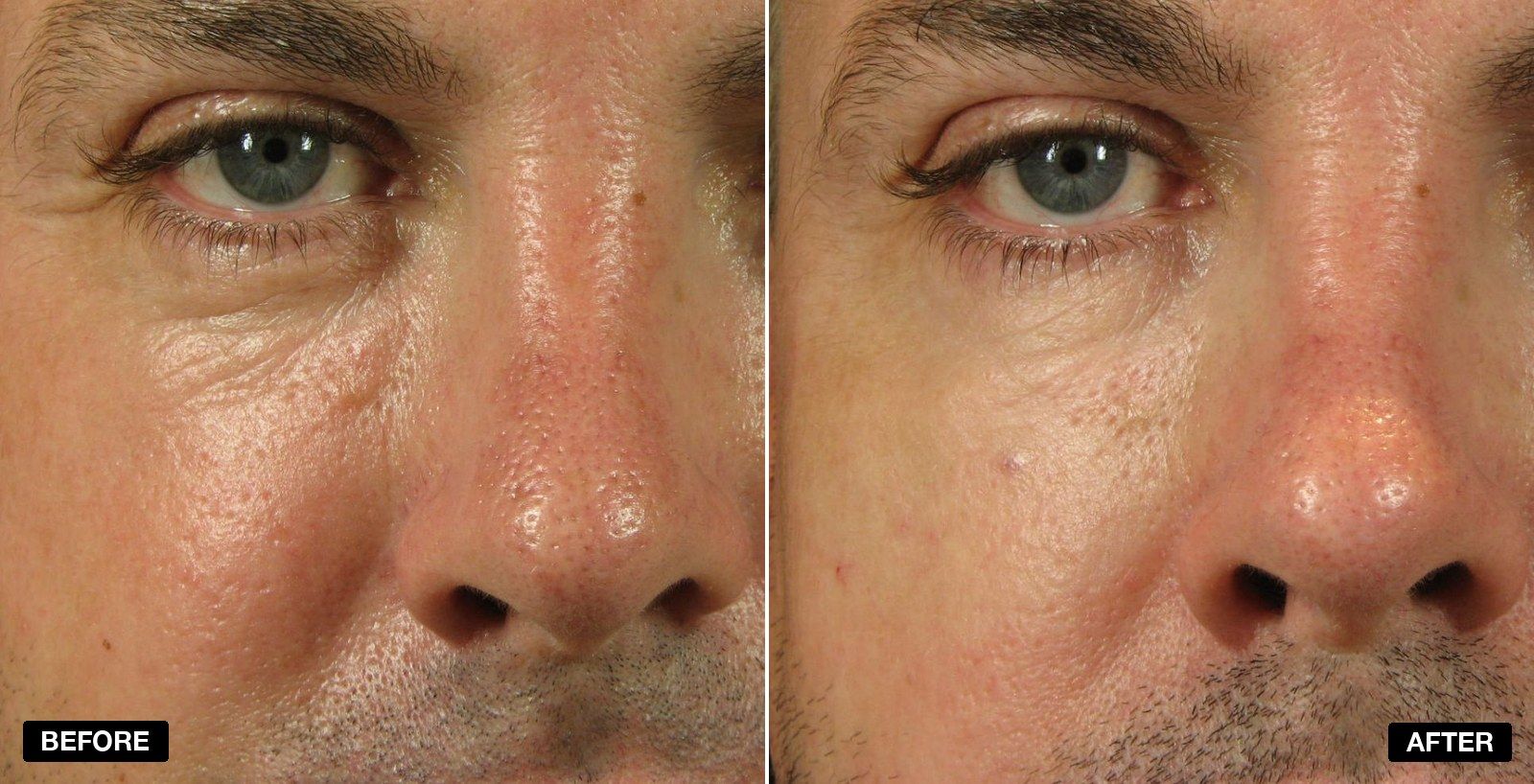 Tear Trough filler before and after - patient case 1 of 13 at PHI Clinic London