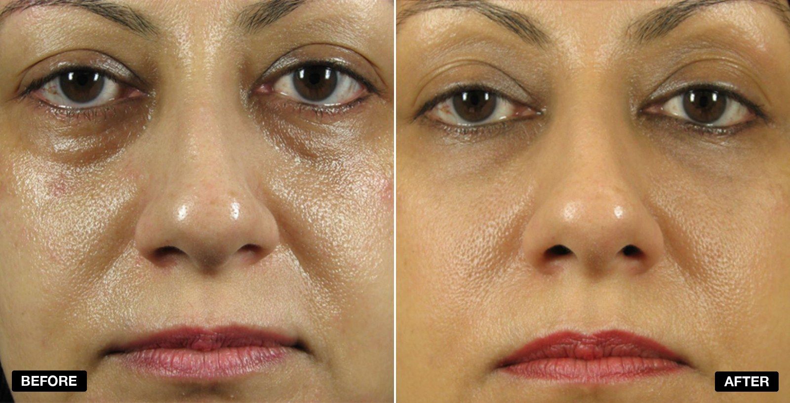 Tear Trough filler before and after - patient case 2 of 13 at PHI Clinic London