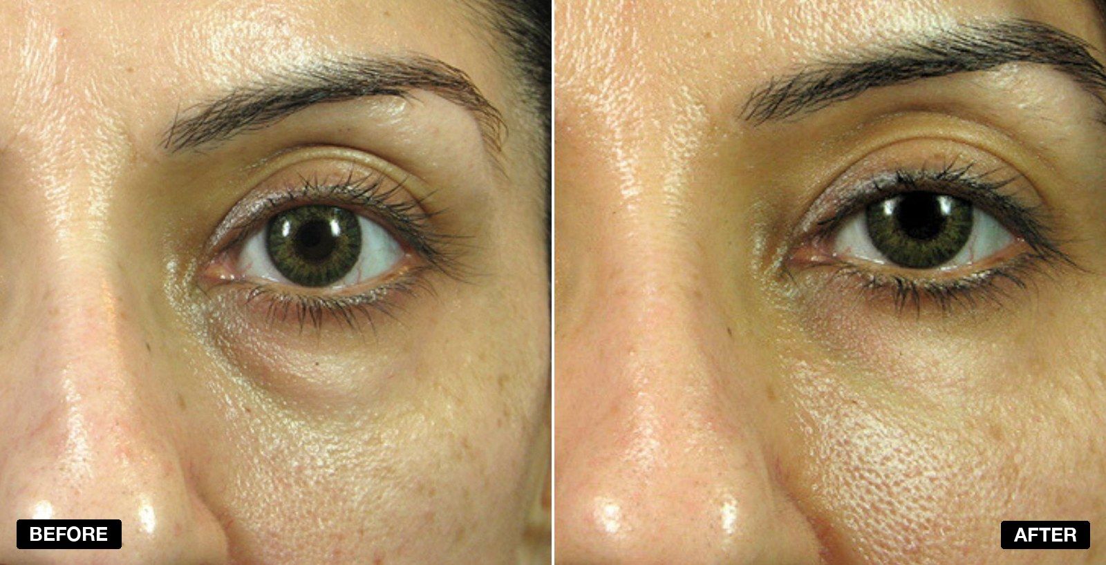 Tear Trough filler before and after - patient case 4 of 13 at PHI Clinic London