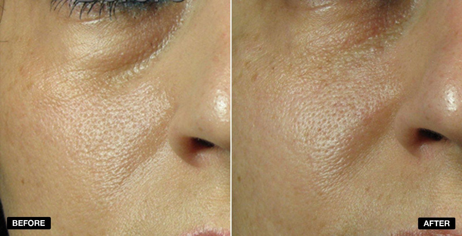 Tear Trough filler before and after - patient case 5 of 13 at PHI Clinic London