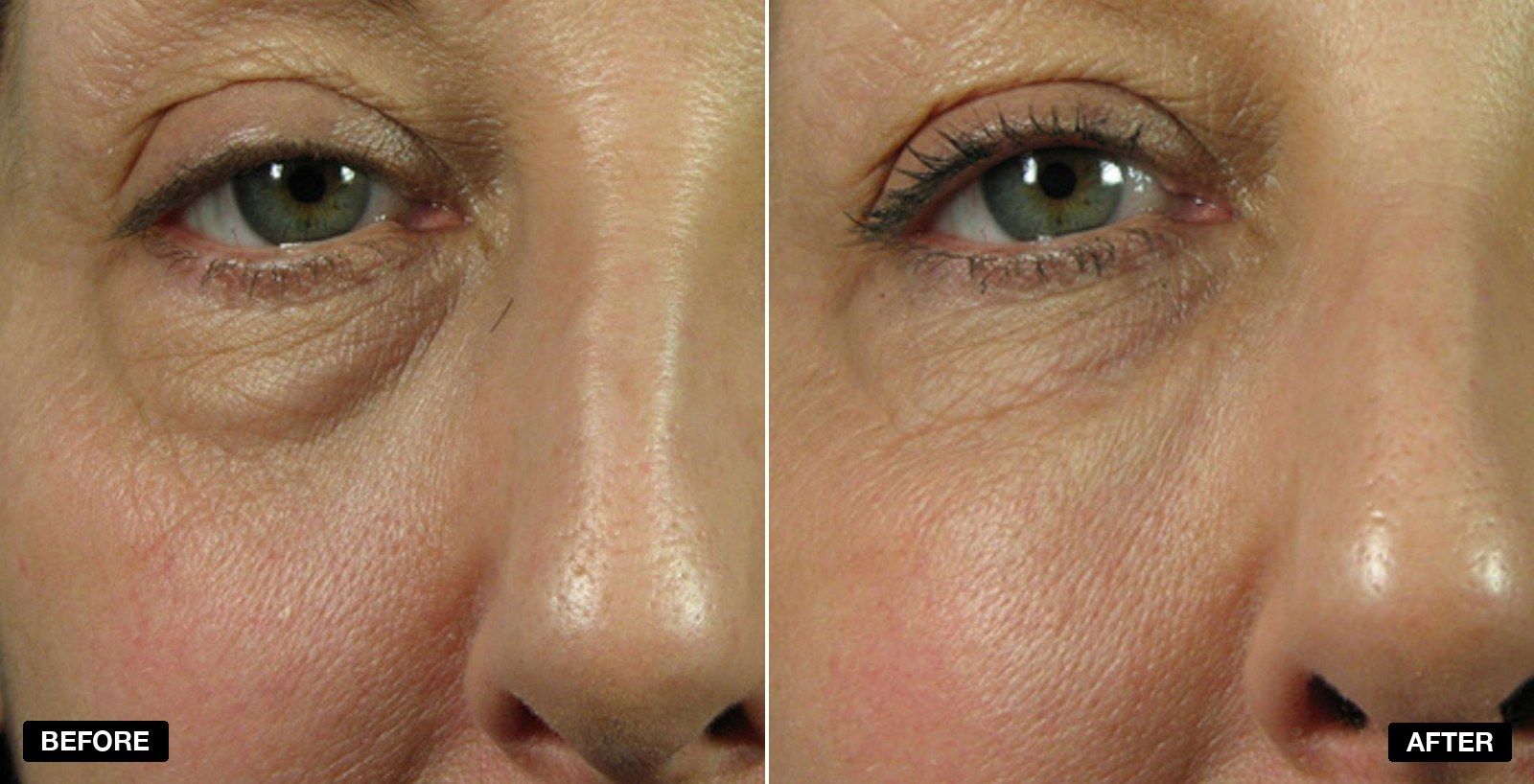 Tear Trough filler before and after - patient case 6 of 13 at PHI Clinic London