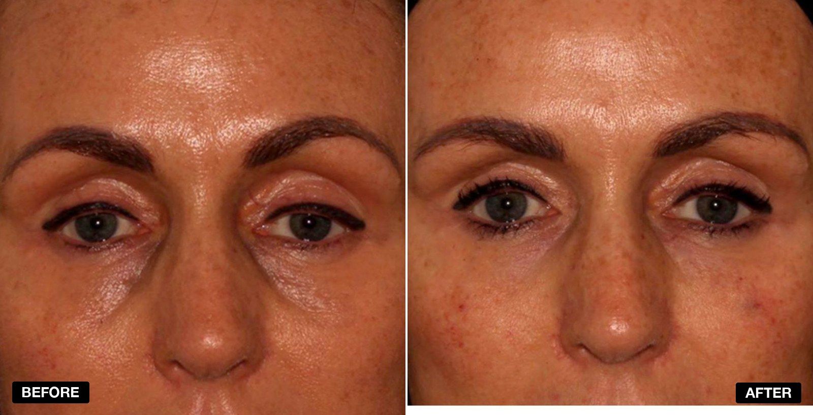 Tear Trough filler before and after - patient case 7 of 13 at PHI Clinic London