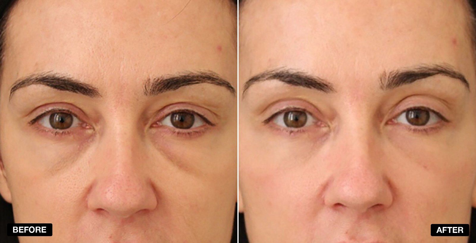 Tear Trough filler before and after - patient case 8 of 13 at PHI Clinic London