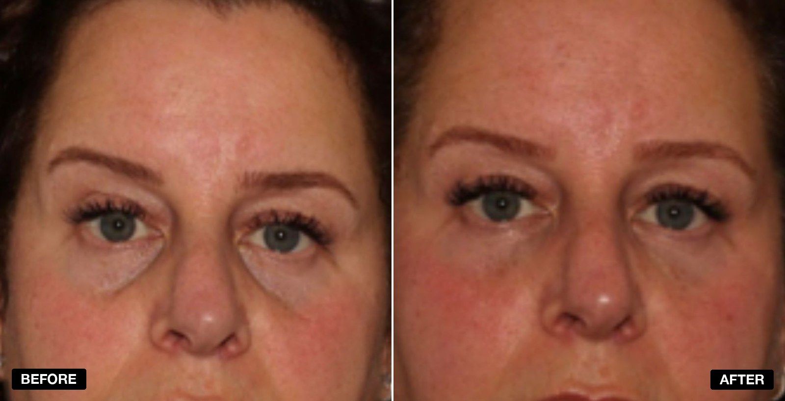 Tear Trough filler before and after - patient case 9 of 13 at PHI Clinic London