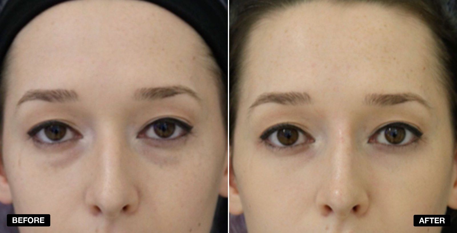 Tear Trough filler before and after - patient case 10 of 13 at PHI Clinic London
