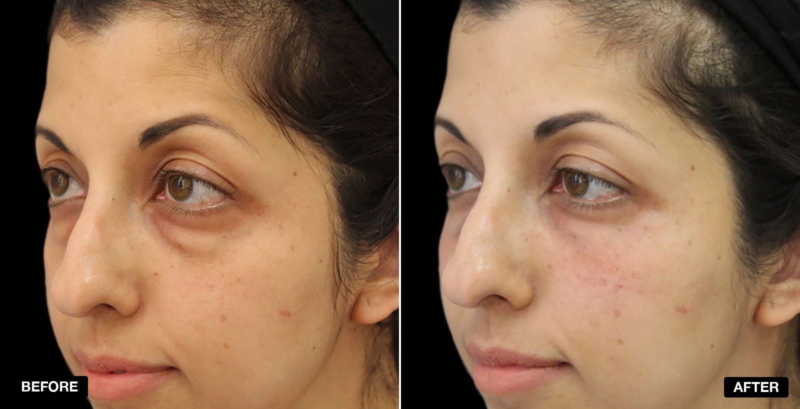 Tear Trough filler before and after - patient case 11 of 13 at PHI Clinic London